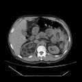 Adrenal myelolipoma (Radiopaedia 41843-44834 Axial non-contrast 23).jpg