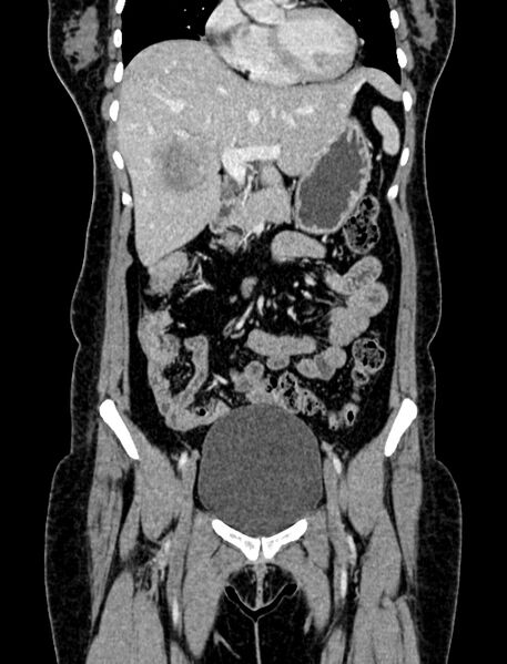 File:Adrenocortical carcinoma (Radiopaedia 87281-103569 Coronal C+ portal venous phase 7).jpg