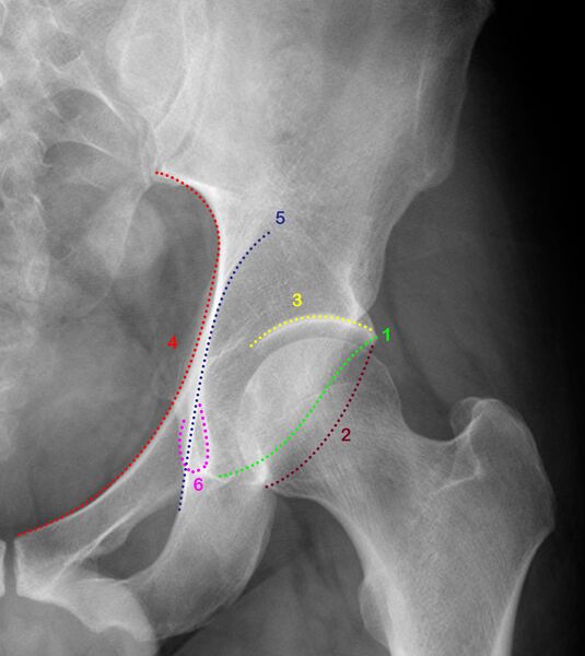 File:Adult normal pelvis- acetabular radiological anatomy (Radiopaedia 42261).jpg