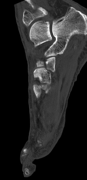 File:Advanced osteomyelitis due to open metatarsal fracture (Radiopaedia 83891-99095 C 12).jpg