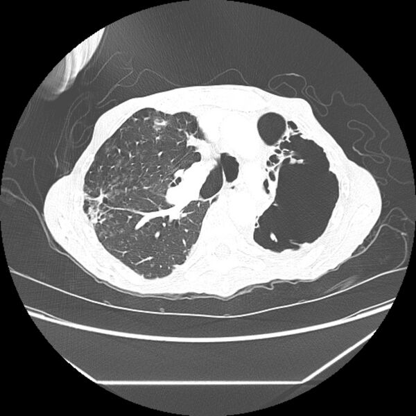 File:Advanced pulmonary tuberculosis (Radiopaedia 8599-9431 Axial lung window 18).jpg