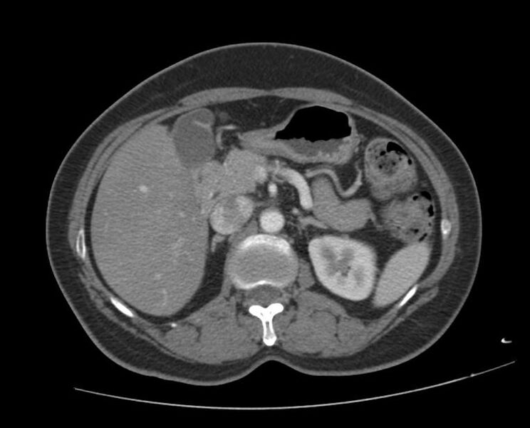File:Agenesis of the dorsal pancreas (Radiopaedia 11180-11545 B 1).jpg