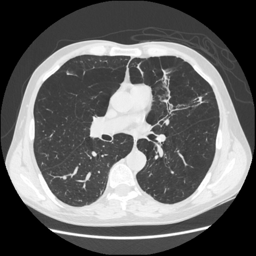 Alpha-1-antitrypsin deficiency (Radiopaedia 40993-43722 Axial lung window 118).jpg