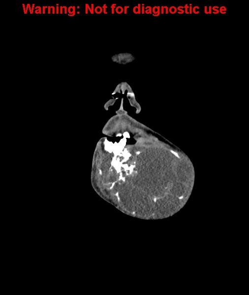 File:Ameloblastoma (Radiopaedia 33126-34164 D 8).jpg