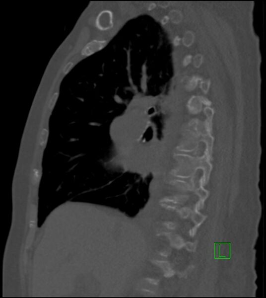 File:Amiodarone deposition in the liver (Radiopaedia 77587-89780 Sagittal bone window 60).jpg
