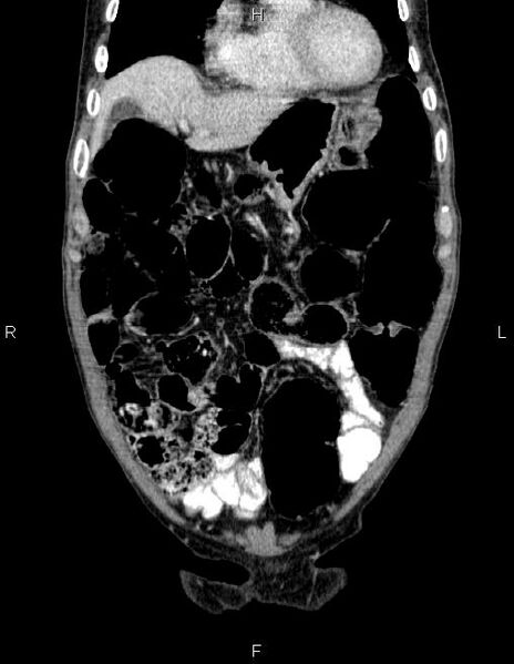 File:Ampullary adenocarcinoma (Radiopaedia 86093-102032 C 15).jpg