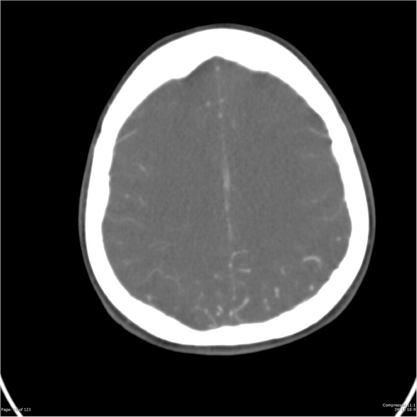 Aneurysmal subarachnoid hemorrhage and Moya Moya disease (Radiopaedia 34306-35593 Axial CT COW 16).jpg