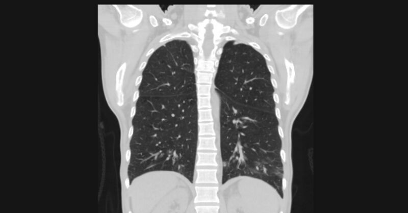 File:Angioinvasive aspergellosis (Radiopaedia 66995-76315 Coronal lung window 45).jpg
