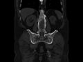 Ankylosing spondylitis (Radiopaedia 44609-48357 Coronal bone window 64).jpg