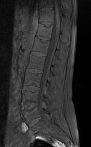 File:Ankylosing spondylitis - Andersson lesion (Radiopaedia 81878-95838 Sagittal T1 fat sat 6).jpg