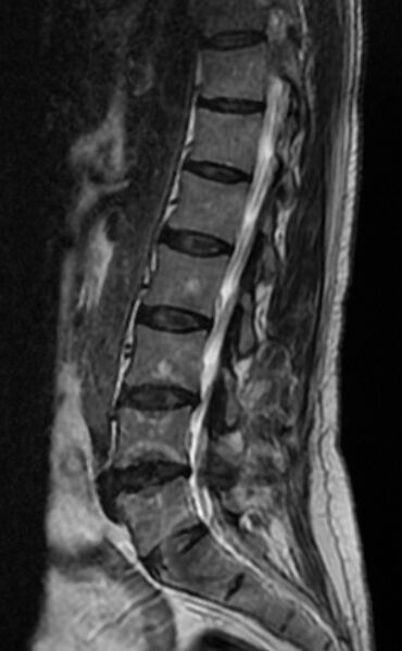 File:Ankylosing spondylitis - Andersson lesion (Radiopaedia 81878-95838 Sagittal T2 8).jpg