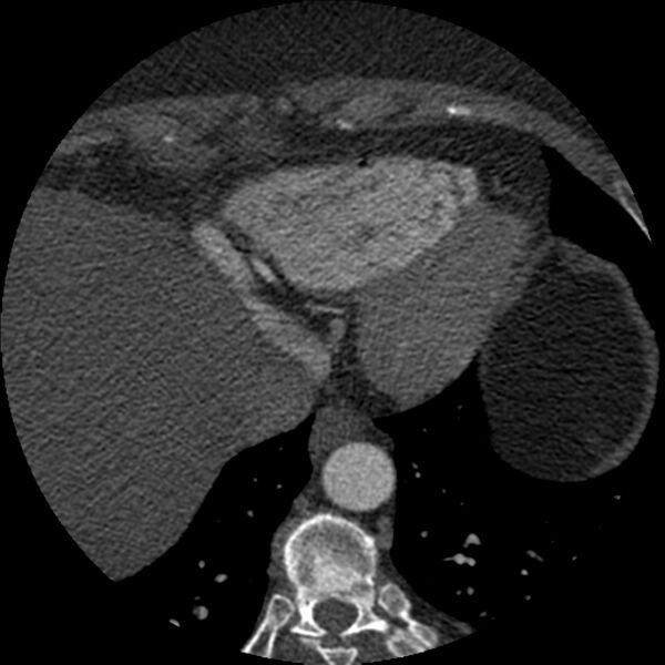 File:Anomalous origin of left circumflex artery from right coronary sinus (Radiopaedia 72563-83117 B 150).jpg