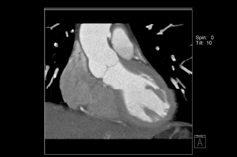 File:Anomalous right coronary artery (ARCA) with interarterial course (Radiopaedia 12423-12677 C 1).jpg