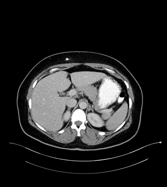 File:Anterior abdominal wall CSF pseudocyst (CSFoma) (Radiopaedia 79453-92571 A 28).jpg