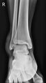 Anterior talofibular ligament injury (Radiopaedia 53338-59319 Frontal 1).jpg