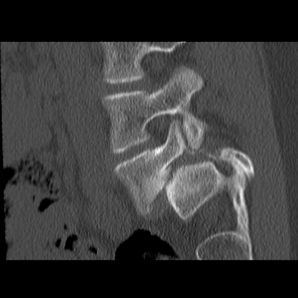 File:Anterolisthesis (Radiopaedia 22226-22263 Sagittal bone window 5).jpg