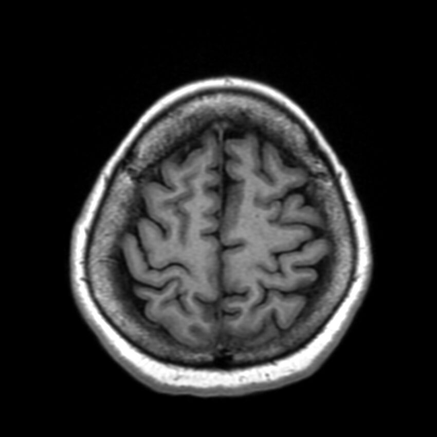 Anti-MOG encephalomyelitis (Radiopaedia 73831-84646 Axial T1 41).jpg