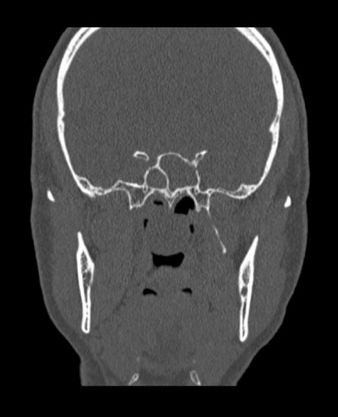 File:Antrochoanal polyp (Radiopaedia 79011-92169 Coronal bone window 20).jpg