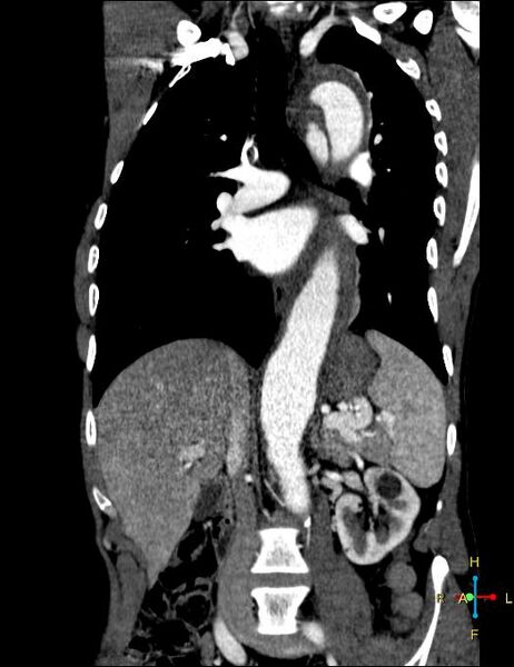 File:Aortic aneurysm and penetrating ulcer (Radiopaedia 23590-23704 B 9).jpg