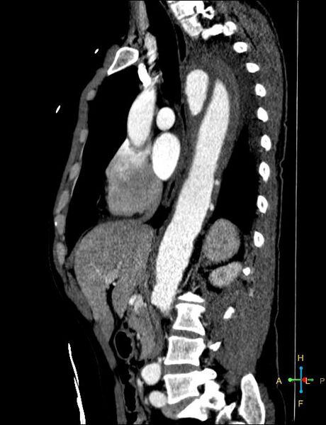 File:Aortic aneurysm and penetrating ulcer (Radiopaedia 23590-23704 C 23).jpg