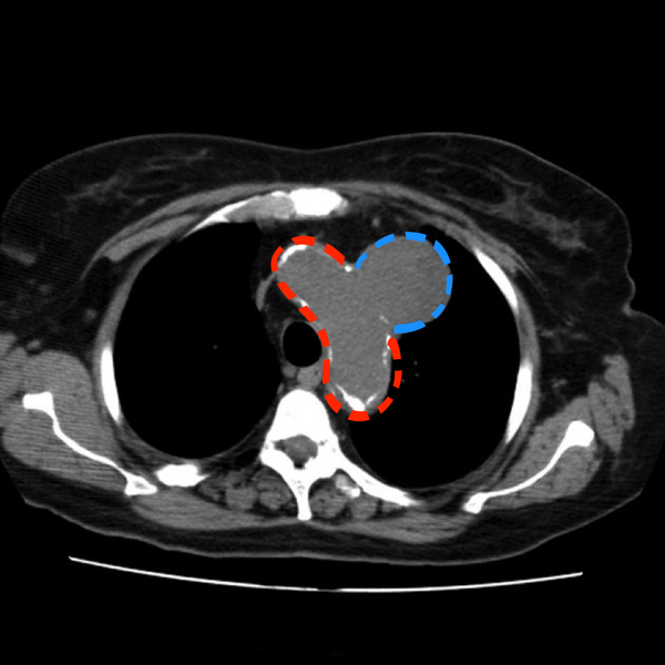 File:Aortic arch pseudoaneurysm (Radiopaedia 8534-20290 B 1).png