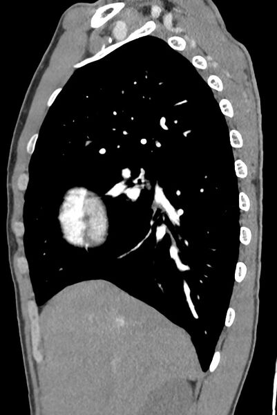 File:Aortic coarctation with aneurysm (Radiopaedia 74818-85828 B 50).jpg