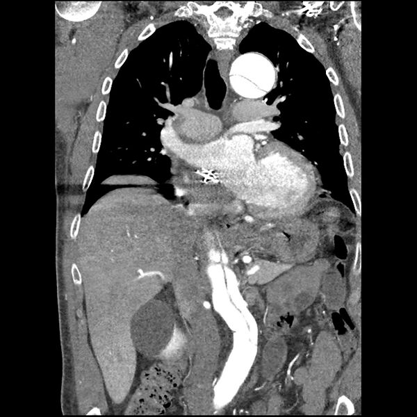 File:Aortic dissection - DeBakey Type I-Stanford A (Radiopaedia 79863-93115 B 19).jpg