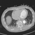 Aortic dissection - DeBakey type II (Radiopaedia 64302-73082 Axial lung window 46).png