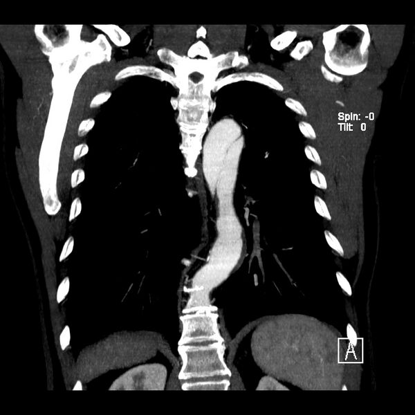 File:Aortic dissection - De Bakey type III - Stanford B (Radiopaedia 21903-21882 C 19).jpg