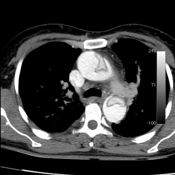 File:Aortic dissection - Stanford type A (Radiopaedia 29247-29659 A 28).jpg