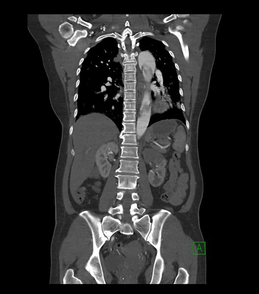 File:Aortic dissection with renal ischemia (Radiopaedia 76573-88338 C 23).jpg