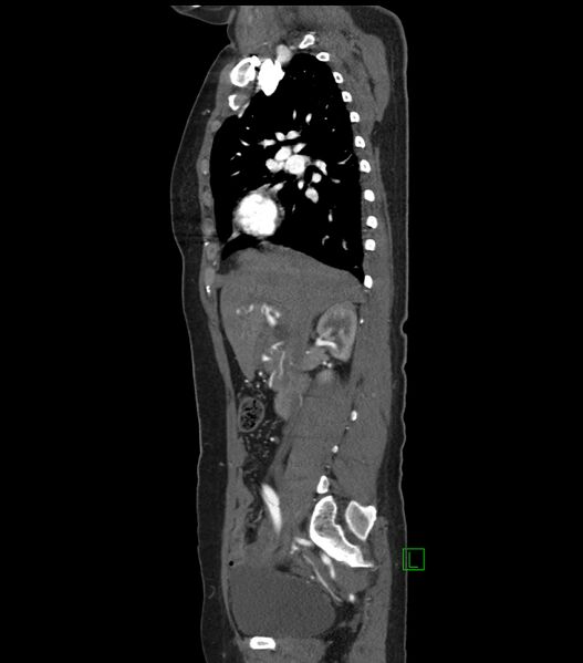 File:Aortic dissection with renal ischemia (Radiopaedia 76573-88338 D 6).jpg