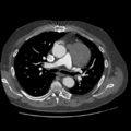 Aorto-coronary bypass graft aneurysms (Radiopaedia 40562-43157 A 47).png