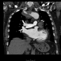 Aorto-coronary bypass graft aneurysms (Radiopaedia 40562-43157 B 22).png
