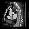 Aorto-coronary bypass graft aneurysms (Radiopaedia 40562-43157 C 18).png