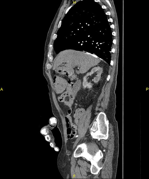 File:Aortoenteric fistula (Radiopaedia 84308-99603 C 112).jpg