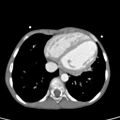 Aortopulmonary window, interrupted aortic arch and large PDA giving the descending aorta (Radiopaedia 35573-37074 B 68).jpg