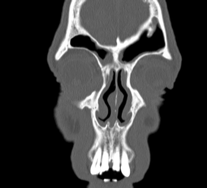 File:Aplastic maxillary sinuses (Radiopaedia 60030-67561 Coronal non-contrast 8).jpg