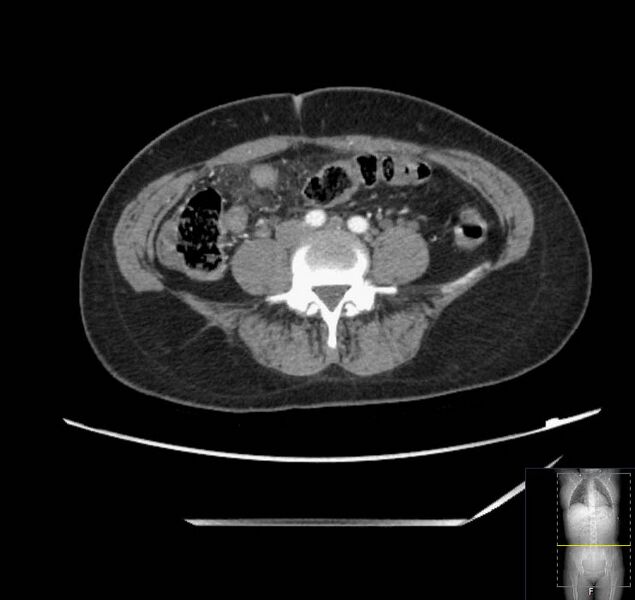 File:Appendicitis (CT angiogram) (Radiopaedia 154713-127660 Axial 39).jpg