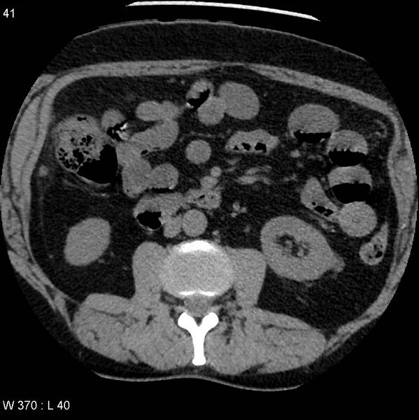 File:Appendicitis (Radiopaedia 12510-12733 Axial non-contrast 8).jpg