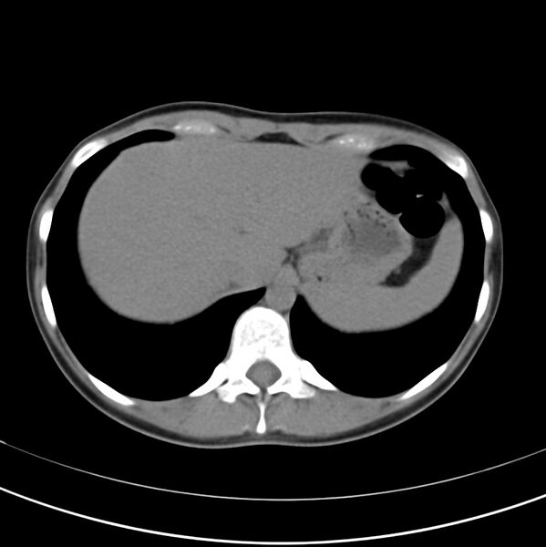 File:Appendicitis and incidental bicornuate uterus (Radiopaedia 22833-22853 Axial non-contrast 8).jpg