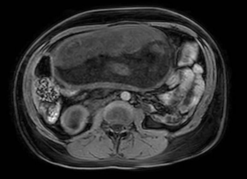 File:Appendicitis in gravida (MRI) (Radiopaedia 89433-106395 Axial DIXON 64).jpg