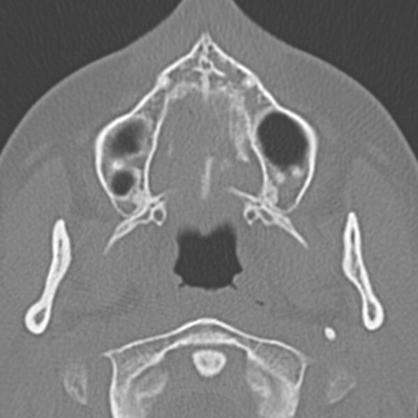 File:Arrested pneumatization of the sphenoid (Radiopaedia 10700-11172 Axial non-contrast 21).jpg