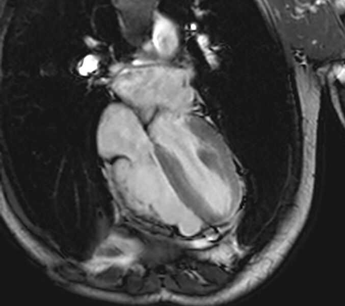 File:Arrhythmogenic right ventricular cardiomyopathy (Radiopaedia 39806-42237 D 45).jpg