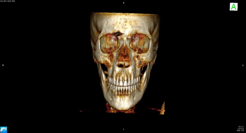 File:Arrow injury to the brain (Radiopaedia 72101-82607 3D bone 2).jpg
