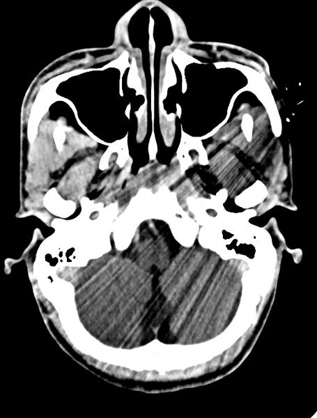 File:Arrow injury to the face (Radiopaedia 73267-84011 Axial C+ delayed 36).jpg