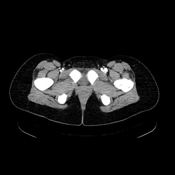 File:Arteriovenous malformation - thigh (Radiopaedia 14948-14883 Axial 65).jpg