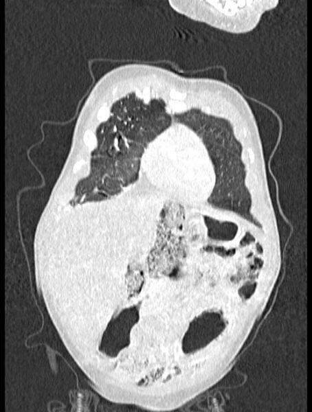 File:Asplenia syndrome (Radiopaedia 73083-83792 Coronal lung window 17).jpg