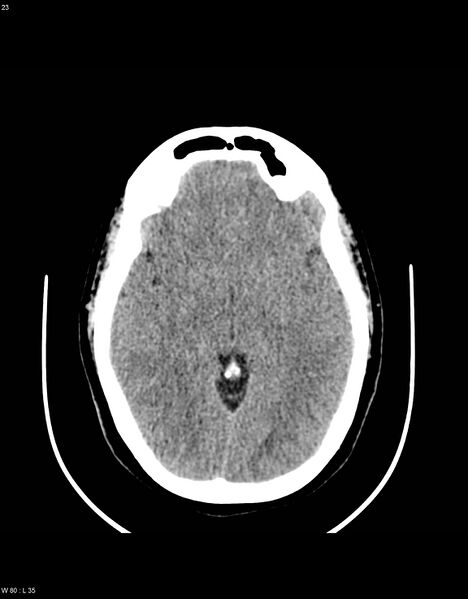 File:Astroblastoma (Radiopaedia 39792-42216 Axial non-contrast 22).jpg