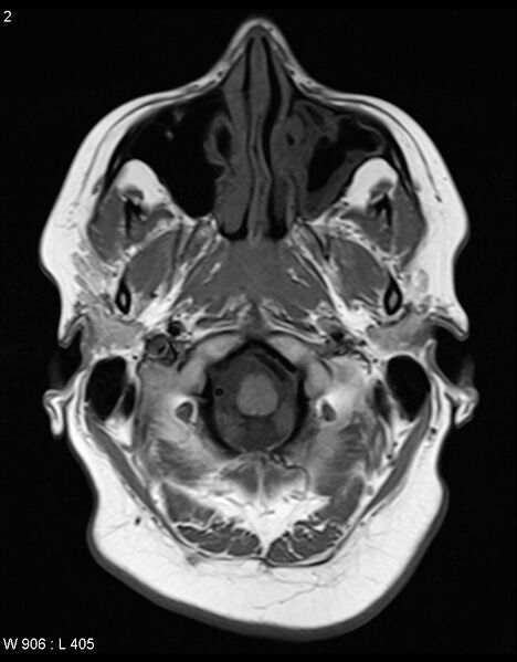 File:Astroblastoma (Radiopaedia 39792-42217 Axial T1 1).jpg